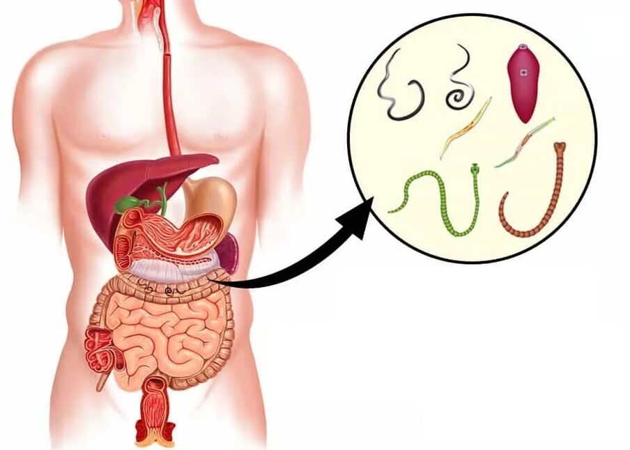 Vermixin ayuda con la mayoría de los tipos de helmintos