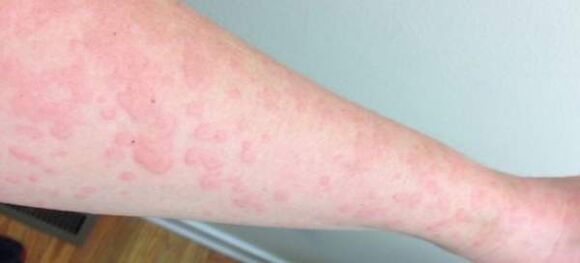 Las alergias cutáneas son un signo de la presencia de parásitos en el cuerpo.